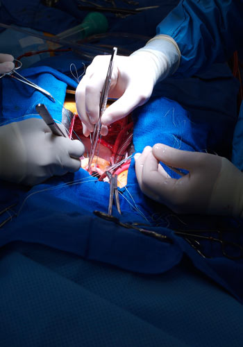 Nephrectomy or open surgery